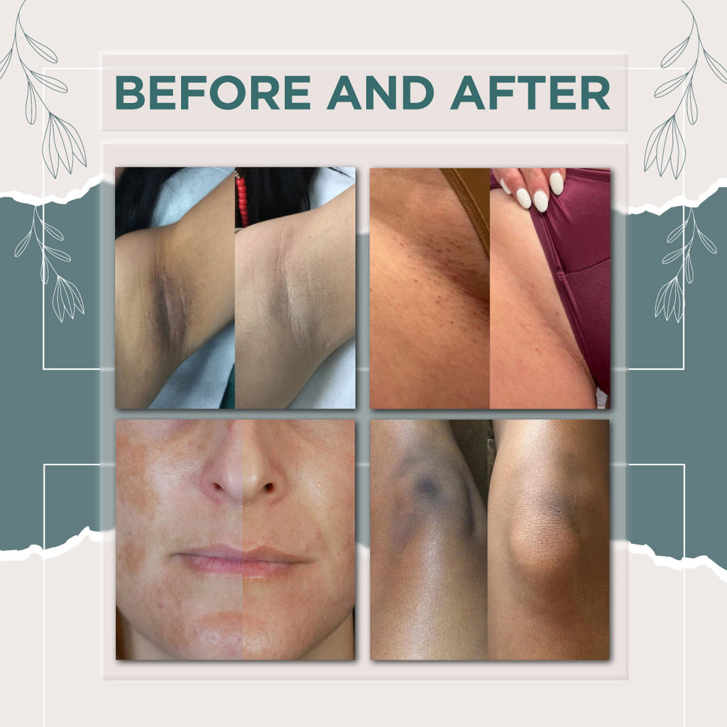 Intimate Area Bleaching Cream